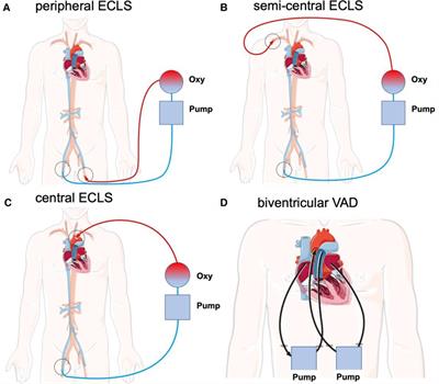 Central extracorporeal circulatory life support (cECLS) in selected patients with critical cardiogenic shock